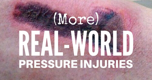 More Real-World Pressure Injuries