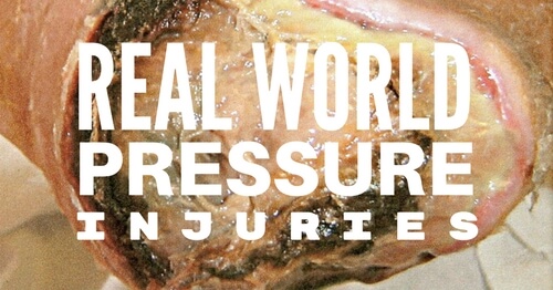 Real World Pressure Injuries