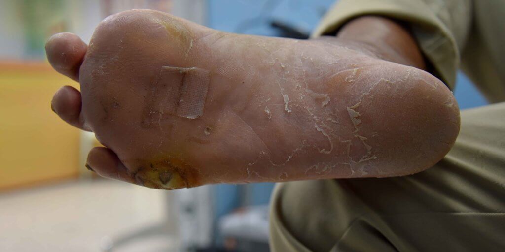 Learn about the Cause and Prevention of Diabetic Foot Ulcers WCEI