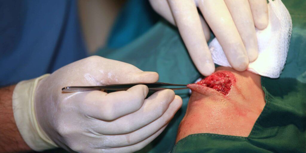 A surgeon checks a wound for retained surgical bodies.