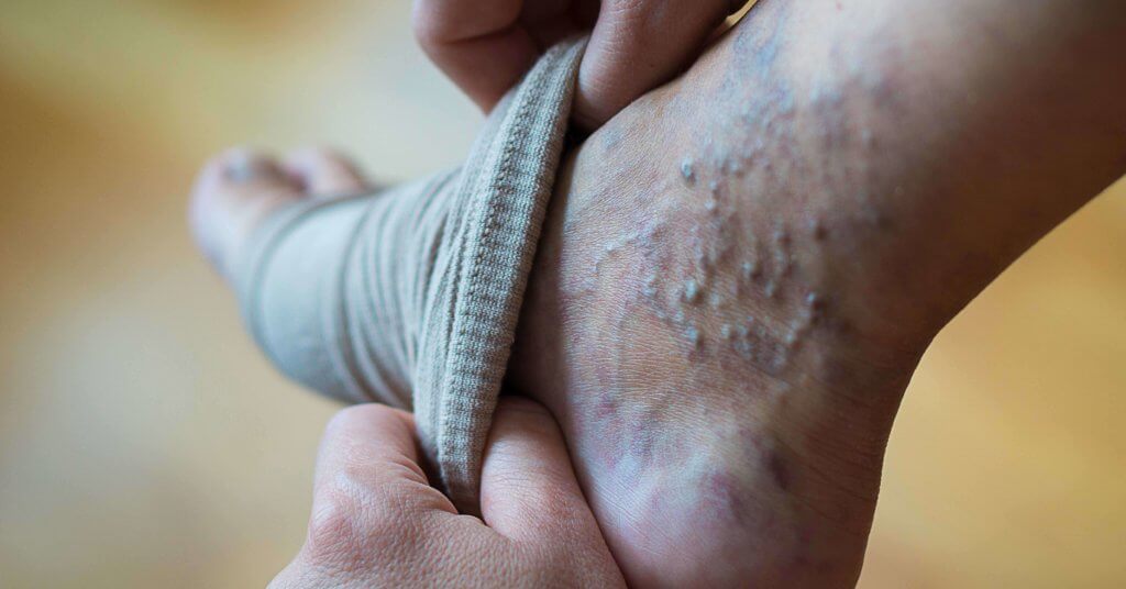 A woman puts on compression stockings.