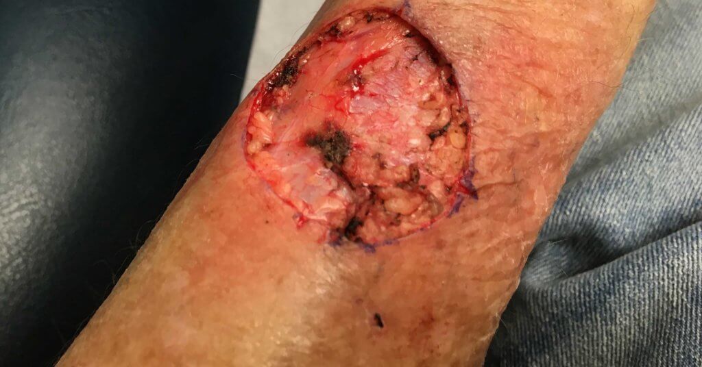 malignant wounds