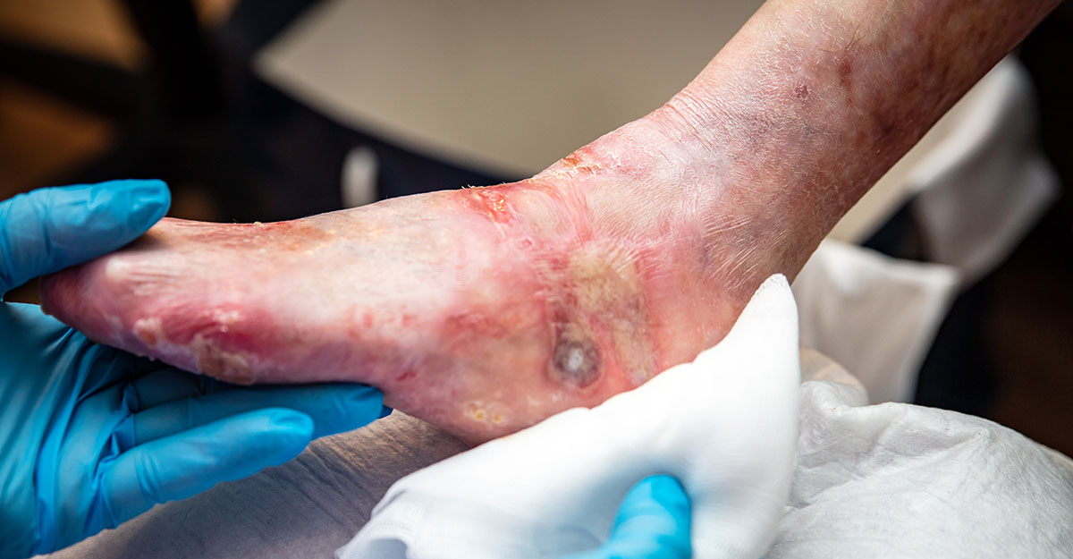 Nurse performing a wound bed assessment