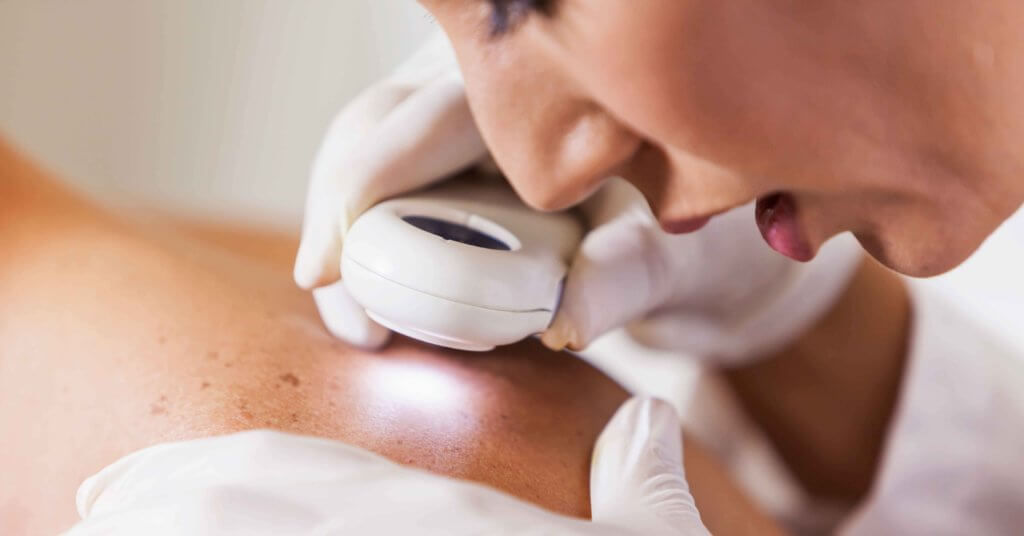 primary skin cancer