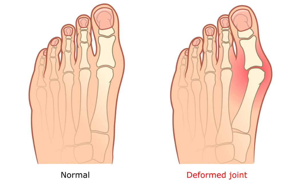 Bunions