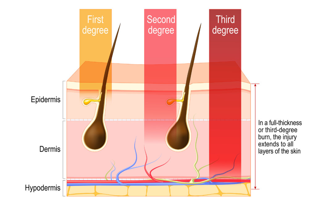 Degrees of burn wounds in emergency wound care