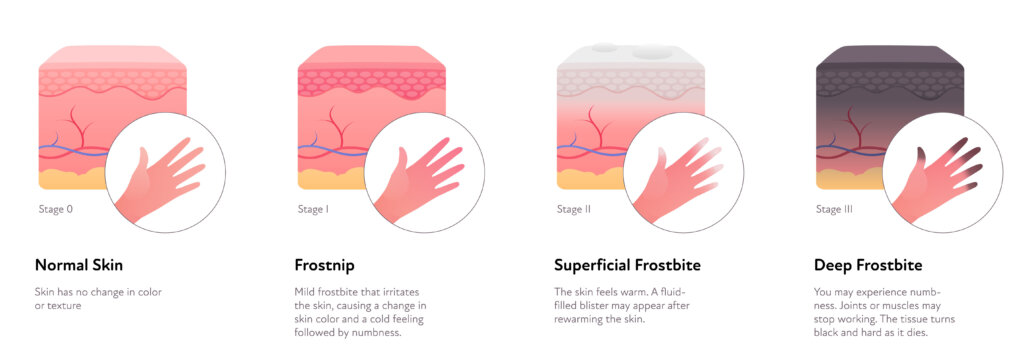 Stages of frostbite for emergency wound care