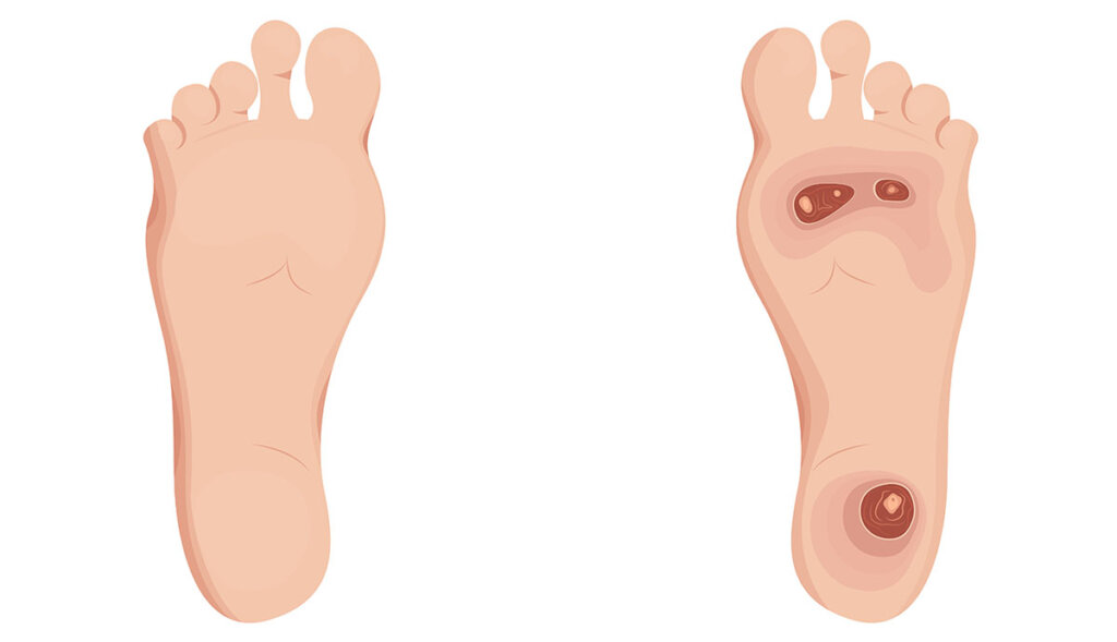 Exostosis in foot