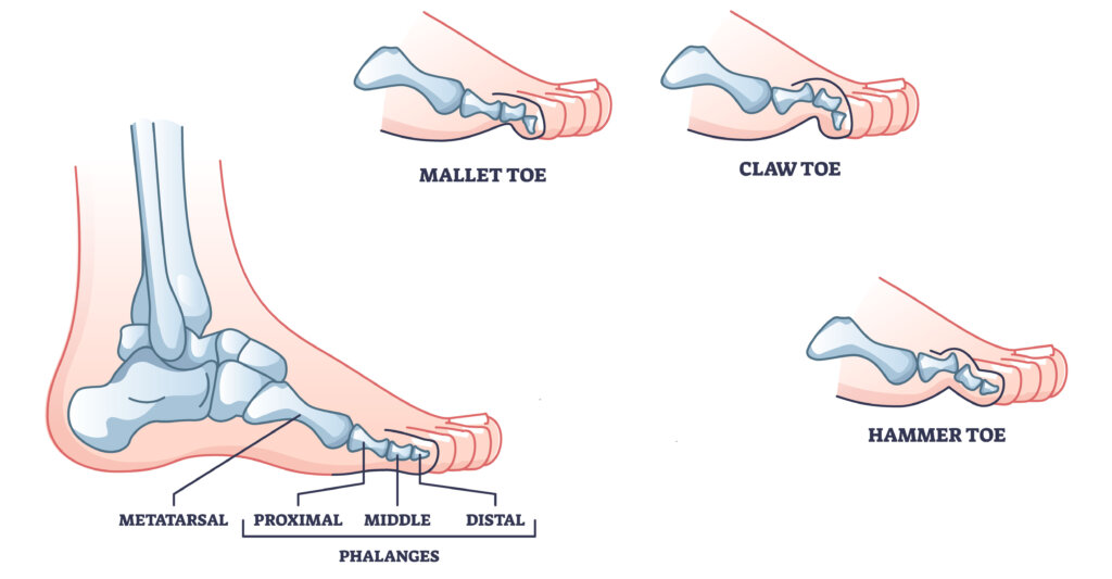 Deformities of the toe