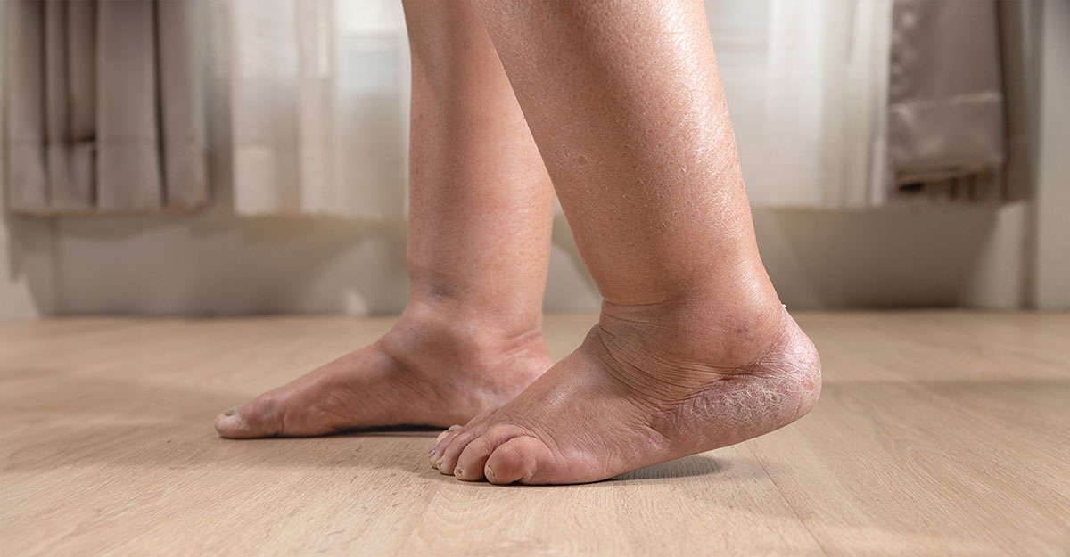 Person with diabetes and foot deformities walking in their bathroom