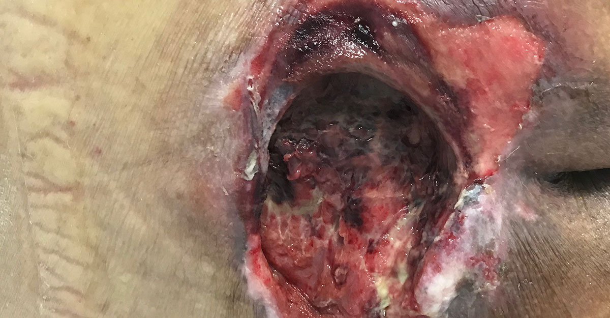 full thickness wound